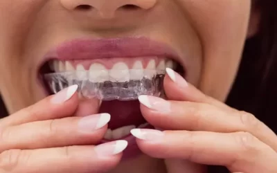 Invisalign Richmond: Clear Aligner Therapy for Discreet Orthodontic Correction